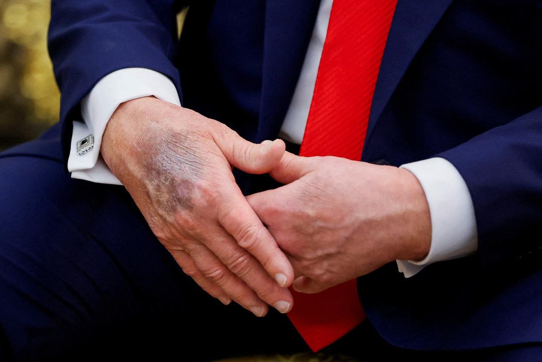 Bu ziyaret sırasında dikkat çekti! Amerika Birleşik Devletleri Başkanı Trump'ın çürüğü gündemdeydi: Bildirge Beyaz Saray 3'ten geldi 3